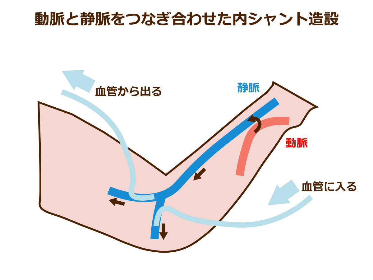 人工透析が必要な高齢者とは|みんなの介護
