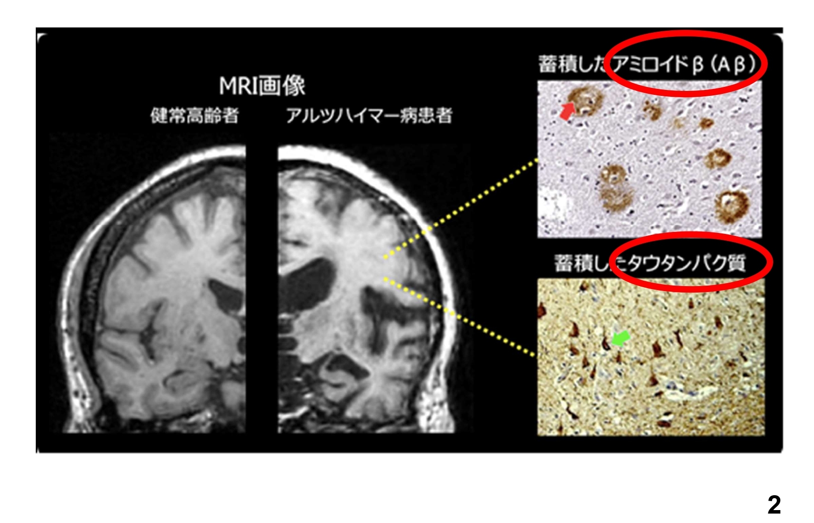 アルツハイマー病発症メカニズムと新規診断法・創薬・治療開発 新井 平伊; 他85名 エーザイのアルツハイマー治療新薬に期待と課題 - 産経ニュース